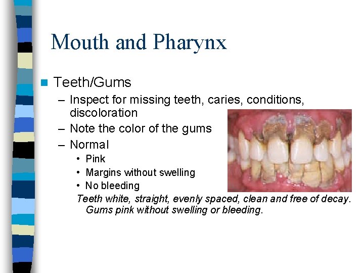 Mouth and Pharynx n Teeth/Gums – Inspect for missing teeth, caries, conditions, discoloration –