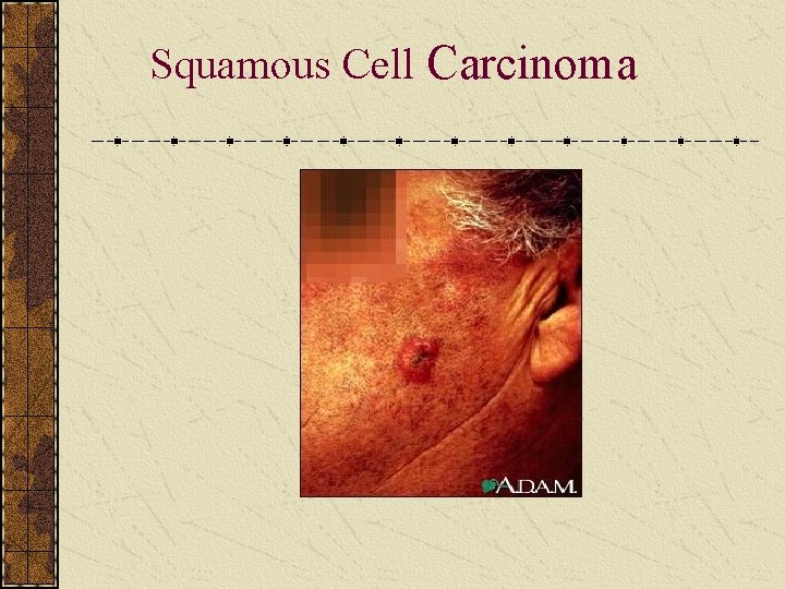 Squamous Cell Carcinoma 