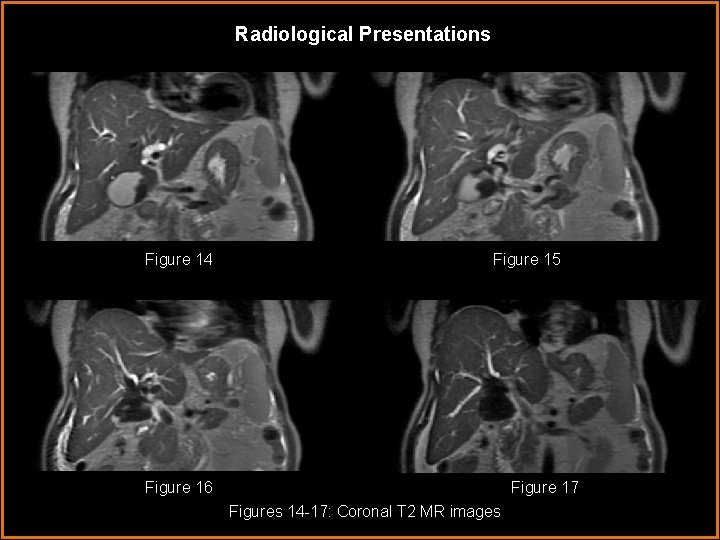 Radiological Presentations Figure 14 Figure 15 Figure 16 Figure 17 Figures 14 -17: Coronal