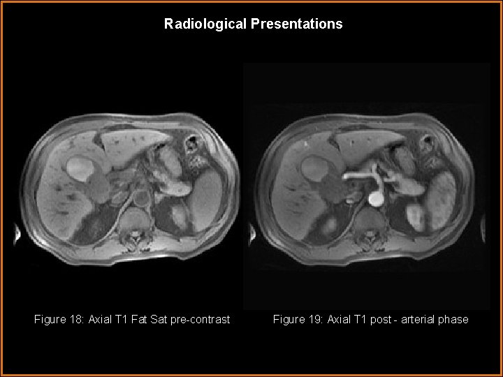 Radiological Presentations Figure 18: Axial T 1 Fat Sat pre-contrast Figure 19: Axial T