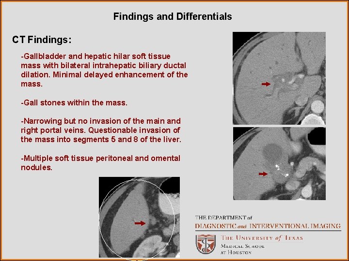 Findings and Differentials CT Findings: -Gallbladder and hepatic hilar soft tissue mass with bilateral