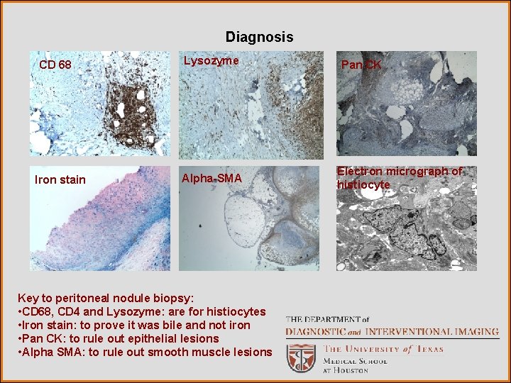Diagnosis CD 68 Iron stain Lysozyme Alpha-SMA Key to peritoneal nodule biopsy: • CD