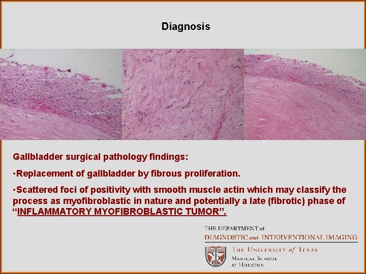 Diagnosis Gallbladder surgical pathology findings: • Replacement of gallbladder by fibrous proliferation. • Scattered