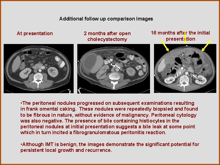 Additional follow up comparison Images At presentation 2 months after open cholecystectomy 16 months