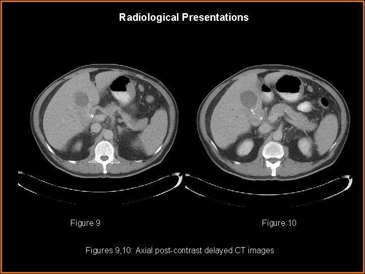Radiological Presentations Figure 9 Figure 10 Figures 9, 10: Axial post-contrast delayed CT images