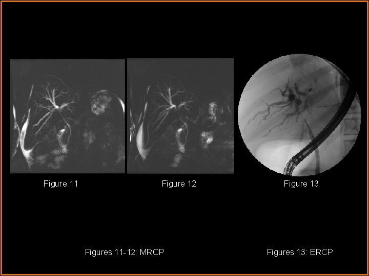 Figure 11 Figure 12 Figures 11 -12: MRCP Figure 13 Figures 13: ERCP 