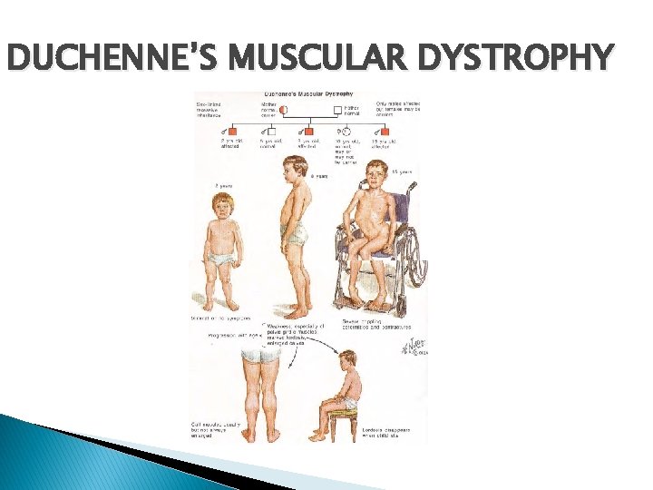 DUCHENNE’S MUSCULAR DYSTROPHY DUCHENNE’S MUSCULAR DYSTROPHY