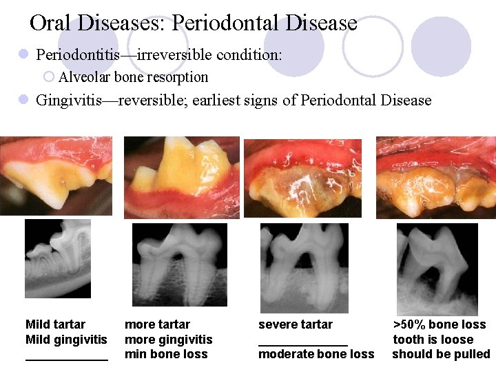 Oral Diseases: Periodontal Disease l Periodontitis—irreversible condition: ¡ Alveolar bone resorption l Gingivitis—reversible; earliest Oral Diseases: Periodontal Disease l Periodontitis—irreversible condition: ¡ Alveolar bone resorption l Gingivitis—reversible; earliest