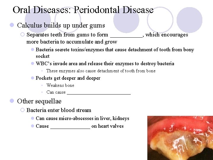 Oral Diseases: Periodontal Disease l Calculus builds up under gums ¡ Separates teeth from Oral Diseases: Periodontal Disease l Calculus builds up under gums ¡ Separates teeth from