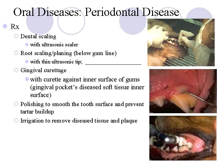 Oral Diseases: Periodontal Disease l Rx ¡ Dental scaling l with ultrasonic scaler ¡ Oral Diseases: Periodontal Disease l Rx ¡ Dental scaling l with ultrasonic scaler ¡