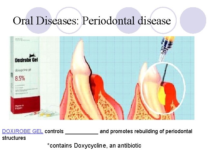 Oral Diseases: Periodontal disease DOXIROBE GEL controls ______ and promotes rebuilding of periodontal structures Oral Diseases: Periodontal disease DOXIROBE GEL controls ______ and promotes rebuilding of periodontal structures