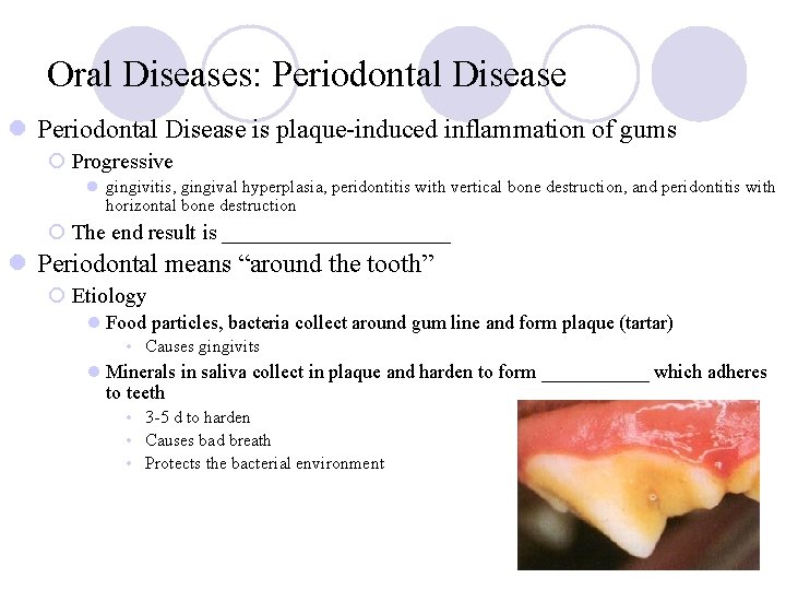 Oral Diseases: Periodontal Disease l Periodontal Disease is plaque-induced inflammation of gums ¡ Progressive Oral Diseases: Periodontal Disease l Periodontal Disease is plaque-induced inflammation of gums ¡ Progressive