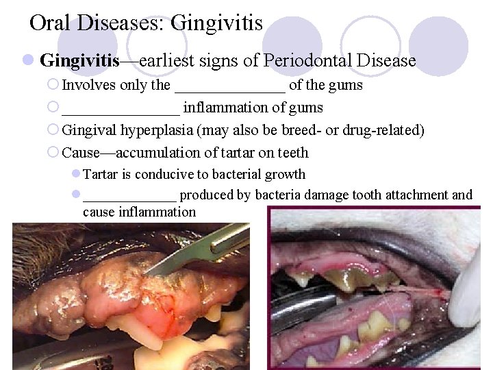 Oral Diseases: Gingivitis l Gingivitis—earliest signs of Periodontal Disease ¡ Involves only the _______ Oral Diseases: Gingivitis l Gingivitis—earliest signs of Periodontal Disease ¡ Involves only the _______