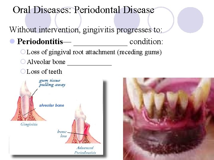 Oral Diseases: Periodontal Disease Without intervention, gingivitis progresses to: l Periodontitis— _______ condition: ¡ Oral Diseases: Periodontal Disease Without intervention, gingivitis progresses to: l Periodontitis— _______ condition: ¡