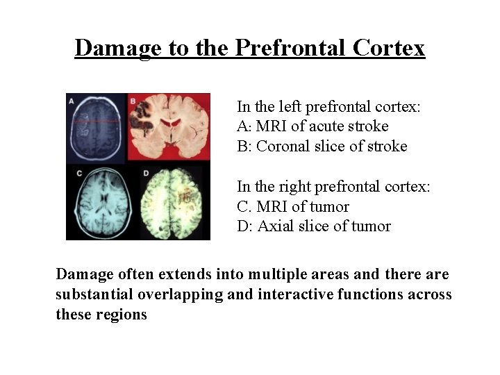 Damage to the Prefrontal Cortex In the left prefrontal cortex: A: MRI of acute