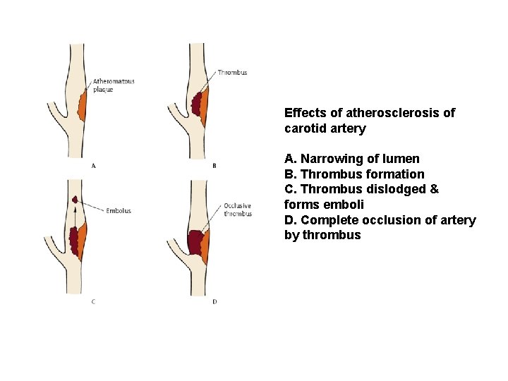 Effects of atherosclerosis of carotid artery A. Narrowing of lumen B. Thrombus formation C.