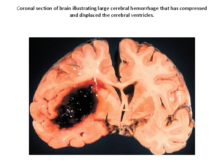 Coronal section of brain illustrating large cerebral hemorrhage that has compressed and displaced the