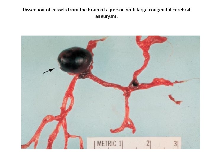 Dissection of vessels from the brain of a person with large congenital cerebral aneurysm.