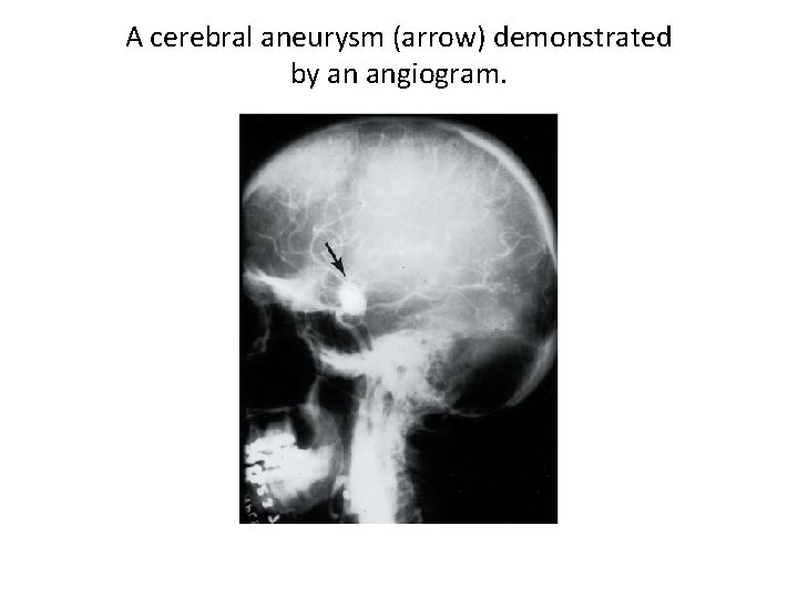 A cerebral aneurysm (arrow) demonstrated by an angiogram. 