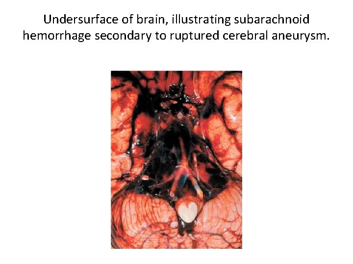 Undersurface of brain, illustrating subarachnoid hemorrhage secondary to ruptured cerebral aneurysm. 