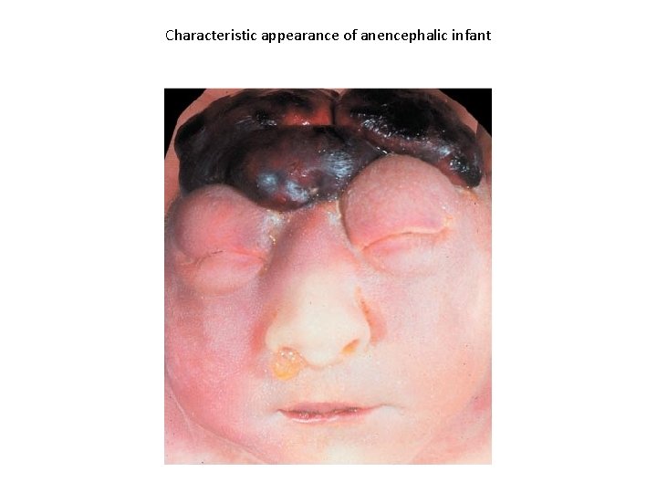 Characteristic appearance of anencephalic infant 