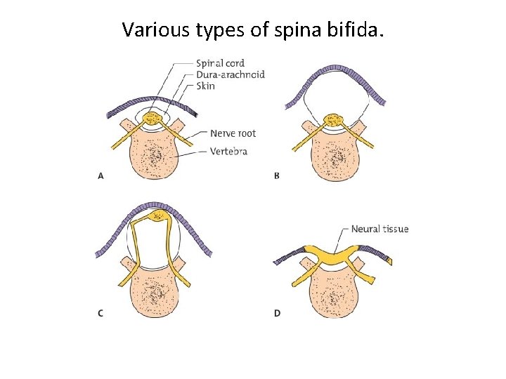 Various types of spina bifida. 