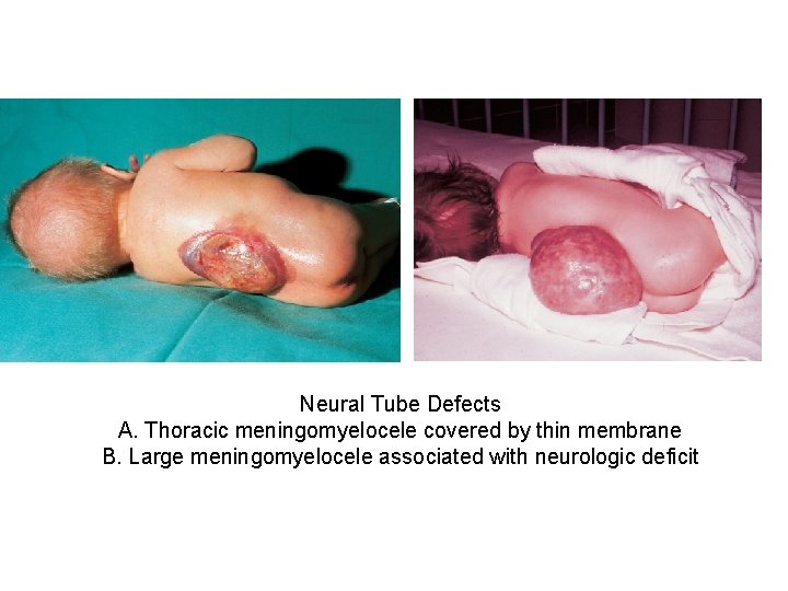 Neural Tube Defects A. Thoracic meningomyelocele covered by thin membrane B. Large meningomyelocele associated