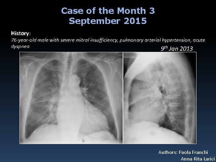 Case of the Month 3 September 2015 History: 76 -year-old male with severe mitral