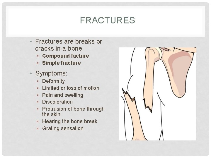 FRACTURES • Fractures are breaks or cracks in a bone. ▫ Compound facture ▫