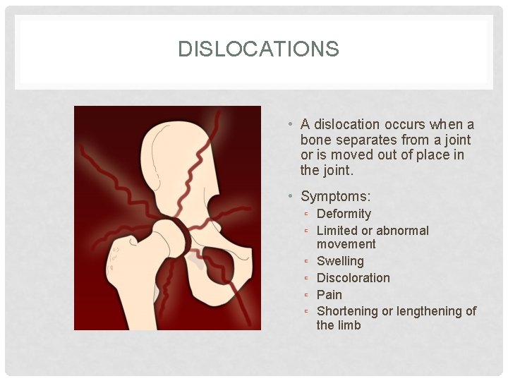 DISLOCATIONS • A dislocation occurs when a bone separates from a joint or is