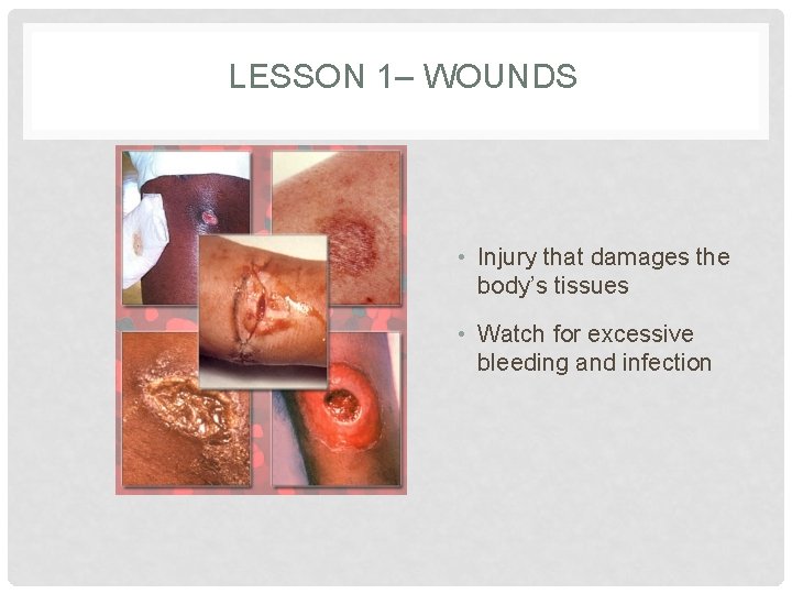 LESSON 1– WOUNDS • Injury that damages the body’s tissues • Watch for excessive