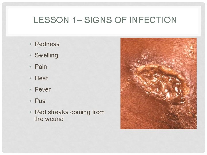 LESSON 1– SIGNS OF INFECTION • Redness • Swelling • Pain • Heat •