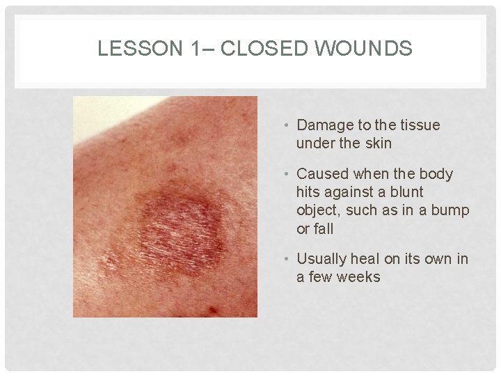 LESSON 1– CLOSED WOUNDS • Damage to the tissue under the skin • Caused