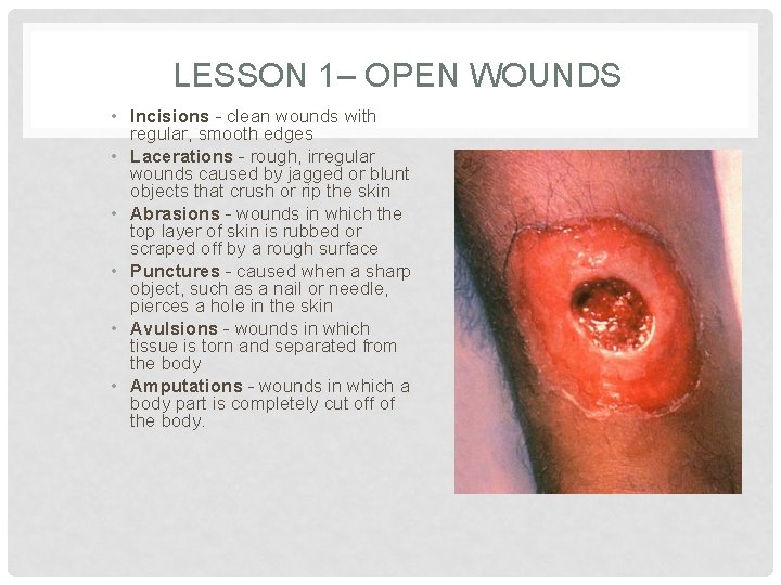 LESSON 1– OPEN WOUNDS • Incisions - clean wounds with regular, smooth edges •