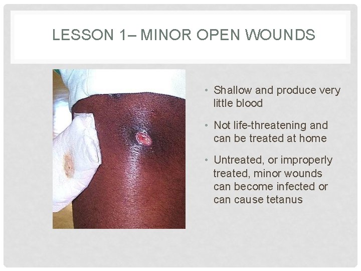 LESSON 1– MINOR OPEN WOUNDS • Shallow and produce very little blood • Not