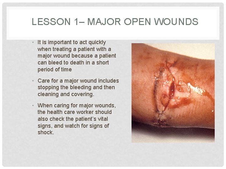 LESSON 1– MAJOR OPEN WOUNDS • It is important to act quickly when treating
