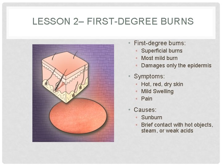 LESSON 2– FIRST-DEGREE BURNS • First-degree burns: ▫ Superficial burns ▫ Most mild burn