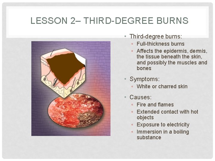 LESSON 2– THIRD-DEGREE BURNS • Third-degree burns: ▫ Full-thickness burns ▫ Affects the epidermis,