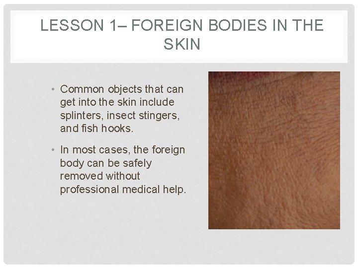LESSON 1– FOREIGN BODIES IN THE SKIN • Common objects that can get into
