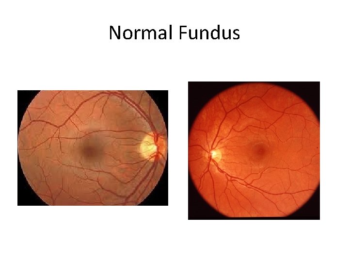 Normal Fundus 