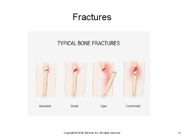 Fractures Copyright © 2019, Elsevier Inc. All rights reserved. 11 