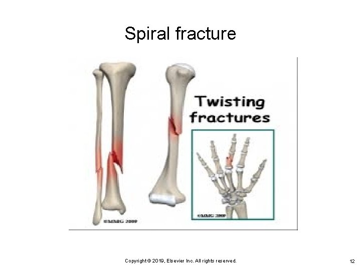 Spiral fracture Copyright © 2019, Elsevier Inc. All rights reserved. 12 