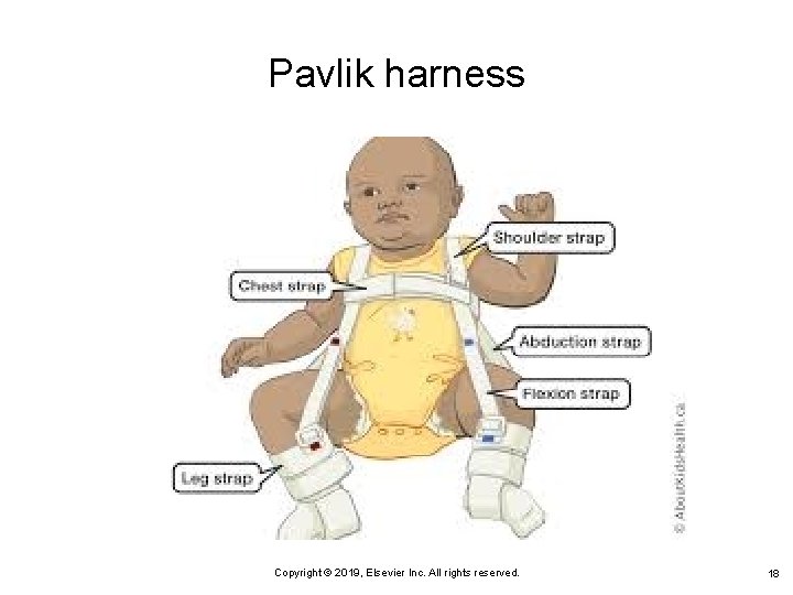 Pavlik harness Copyright © 2019, Elsevier Inc. All rights reserved. 18 