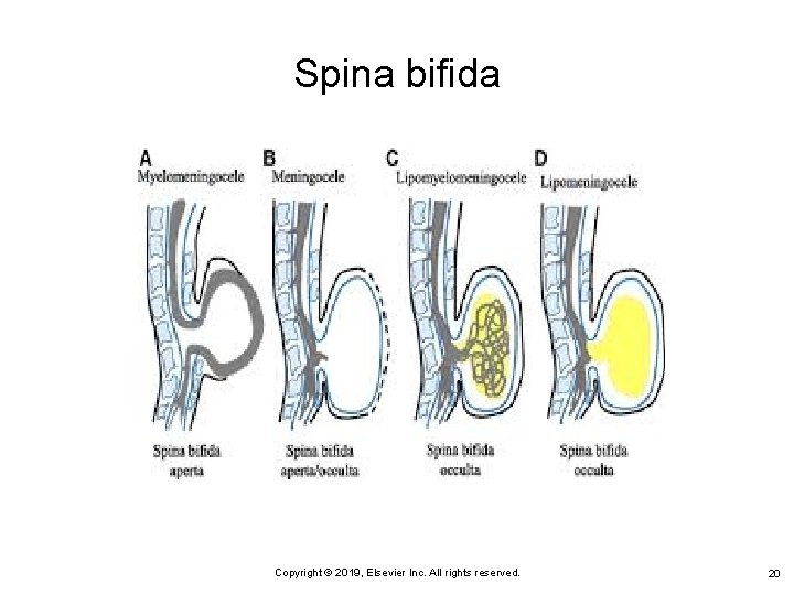 Spina bifida Copyright © 2019, Elsevier Inc. All rights reserved. 20 