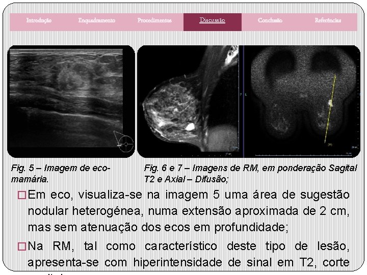 Introdução Enquadramento Fig. 5 – Imagem de ecomamária. Procedimentos Discussão Conclusão Referências Fig. 6