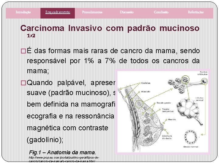 Introdução Enquadramento Procedimentos Discussão Conclusão Referências Carcinoma Invasivo com padrão mucinoso ¹’² � É