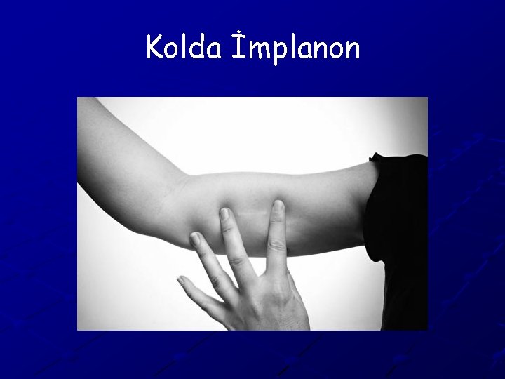 Kolda İmplanon 