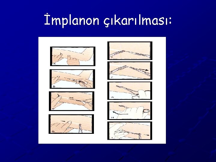 İmplanon çıkarılması: 