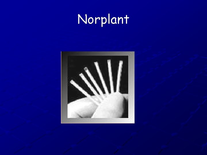 Norplant 