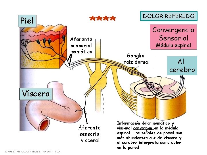 Piel **** Aferente sensorial somático DOLOR REFERIDO Convergencia Sensorial Médula espinal Ganglio raíz dorsal